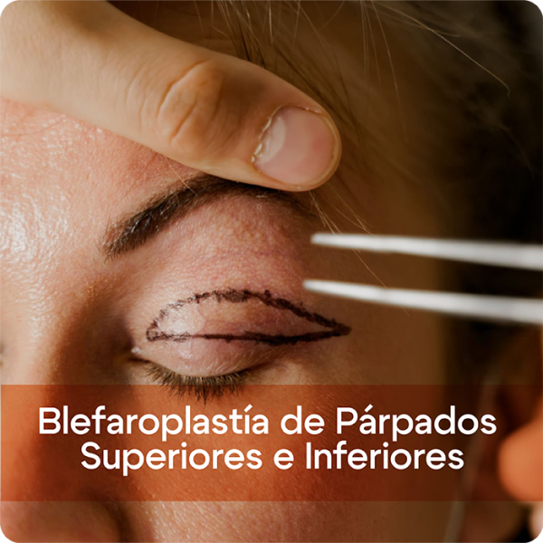 Blefaroplastía de Párpados