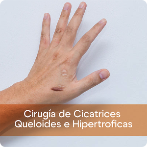 Cirugía de Cicatrices Queloides e Hipertróficas