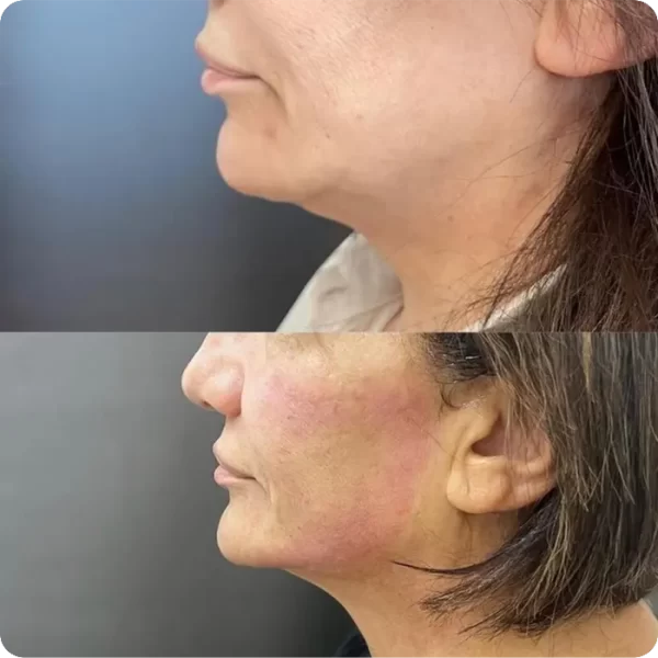 Cirugía de Rejuvenicimiento Facial de Cara y Cuello 02