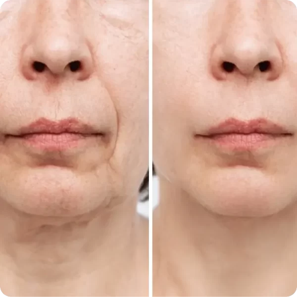Cirugía de Rejuvenicimiento Facial de Cara y Cuello