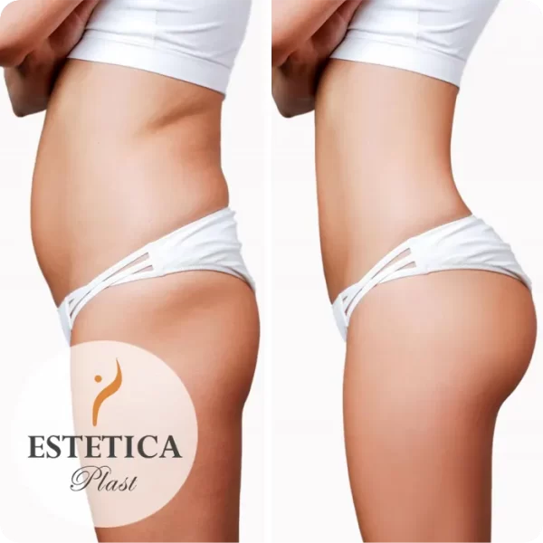 Lipoescultura con Lipotransferencia en Glúteos 01