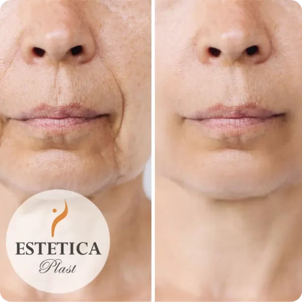 Minilifting de Tercio Superior, Medio e Inferior del Rostro 02