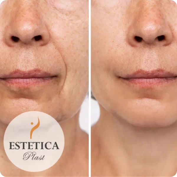 Minilifting de Tercio Superior, Medio e Inferior del Rostro