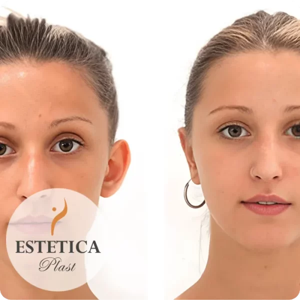 Perfiloplastía, Otoplastía, Mentoplastía y Bichectomía - 01