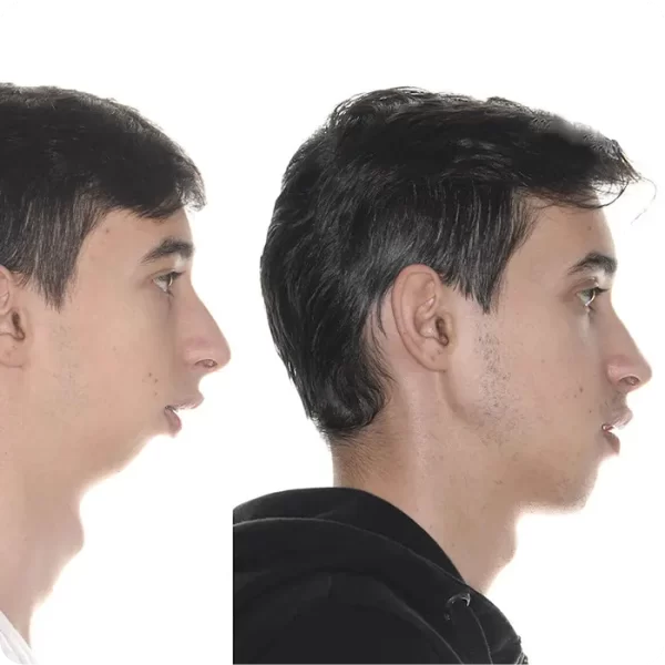 Perfiloplastía, Otoplastía, Mentoplastía y Bichectomía - 01