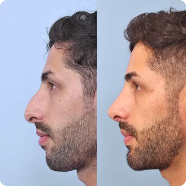 Perfiloplastía, Otoplastía, Mentoplastía y Bichectomía - 02