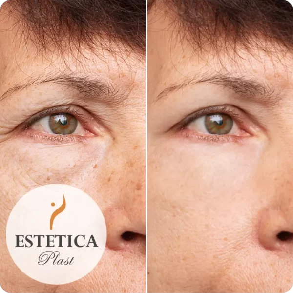 Rejuvenecimiento Quirúrgico de la Frente - 0001