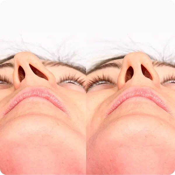 Rejuvenecimiento Quirúrgico de la Frente - 03