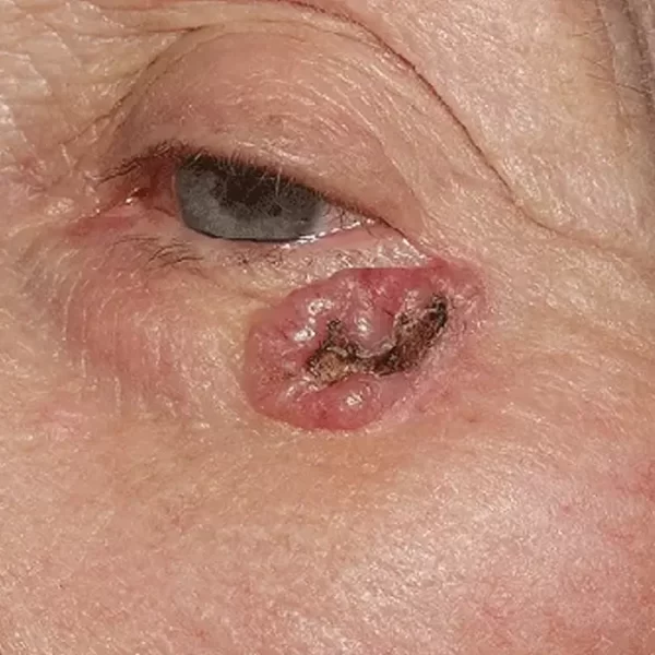 Retiro de Carcinomas Basocelulares y Espinocelulares0