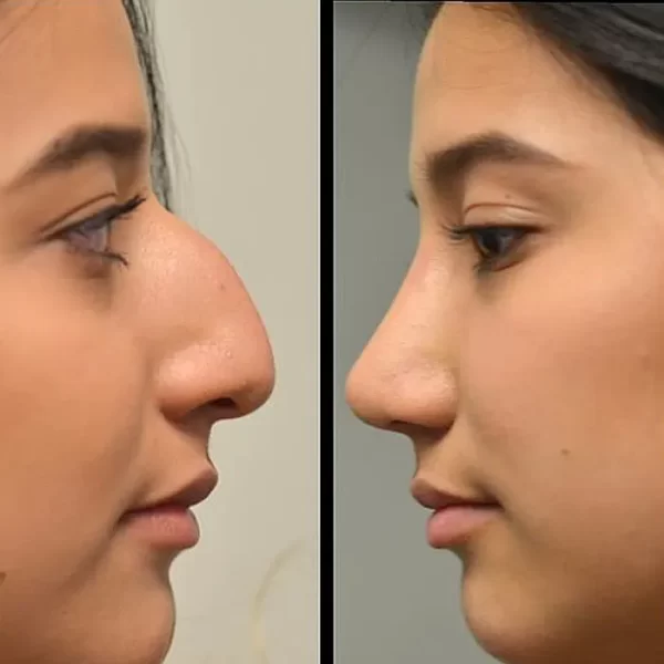 Rinoplastía Estética 02