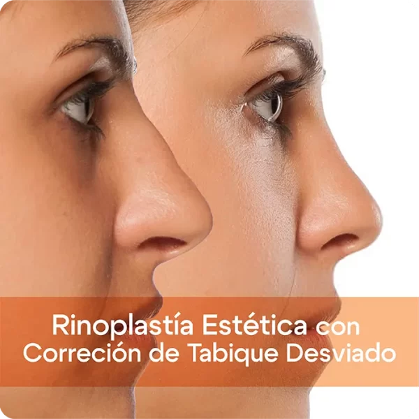 Rinoplastia Estetica