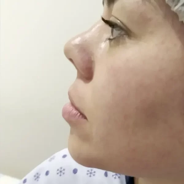 Rinoplastía Estética01