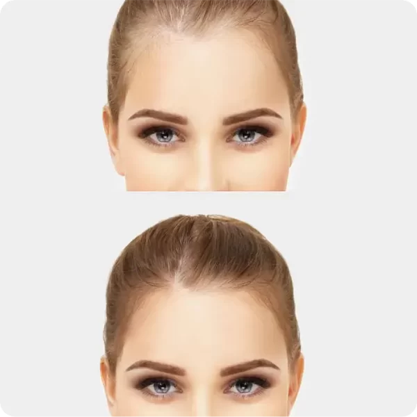 Trasplante de Pelo con Técnica FUE 02