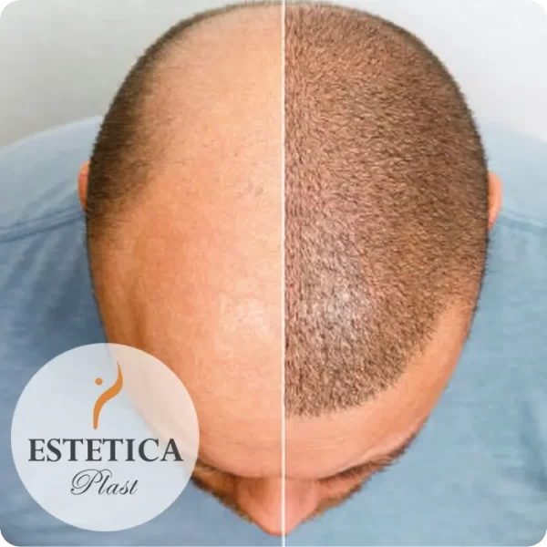 Trasplante de Pelo con Técnica FUE